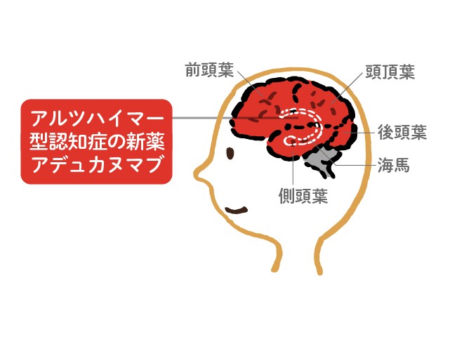 話題のアルツハイマー型認知症の新薬 アヂュカヌマブについて専門医が解説します