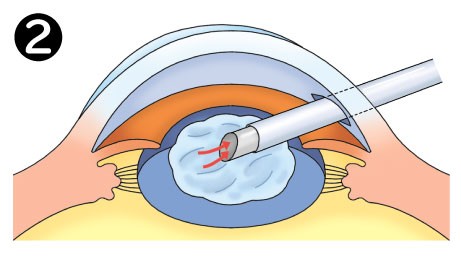 水晶体のにごりを除去 水晶体周囲を覆っている嚢(カプセル)の一部を切り取り、内容物を超音波で砕いて吸い取る。