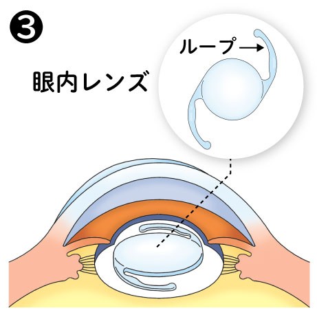 眼内レンズを装着 中身を取り除いた水晶体嚢のなかに、眼内レンズを挿入する。レンズはループで固定される。