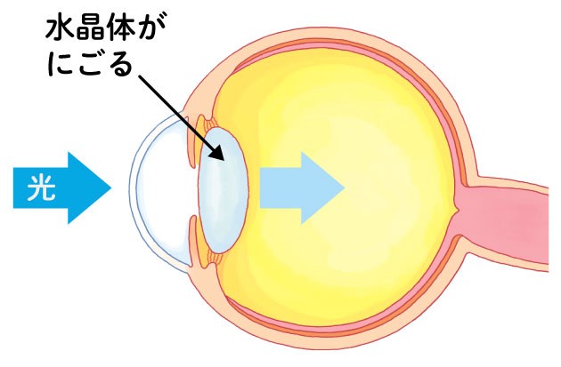 外から入った光は水晶体によって、屈折して、網膜に像を映す。水晶体が濁ると、光がうまく屈折せず、網膜に鮮明な像が結べなくなる。