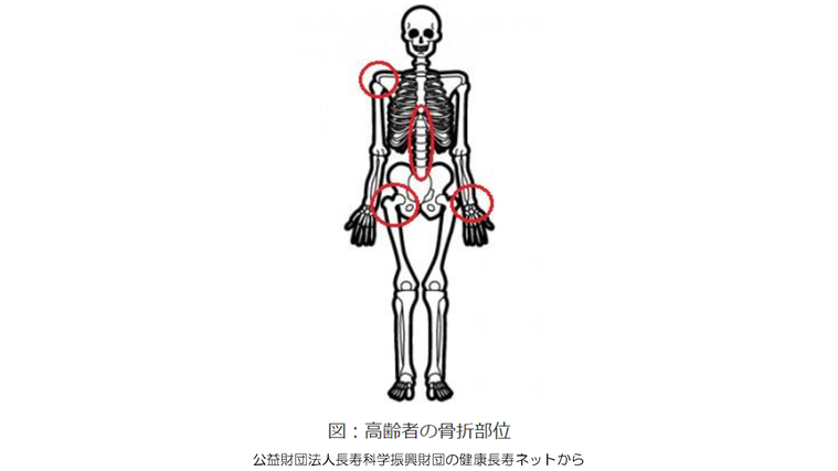 高齢者の骨折部位