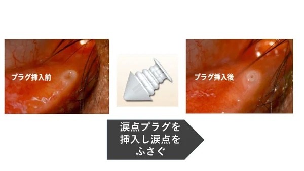 涙点プラグを挿入し涙点をふさぐ