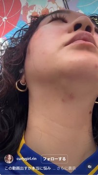 ヒゲを処理することで炎症やニキビが（カーリーガールリンさん提供）