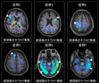 認知症の原因物質、中高齢のうつ発症と関連か　高い割合で脳に蓄積