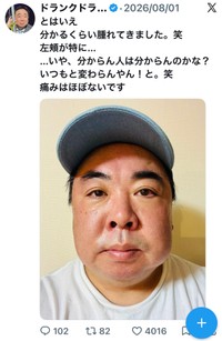 抜歯で腫れた左頬を披露する塚地武雅さん＝塚地武雅（@tsukajimuga）さんのXより