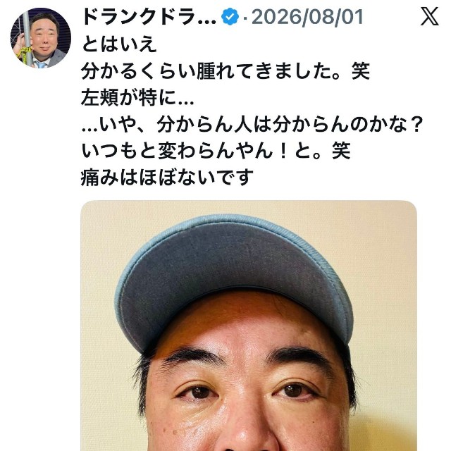 抜歯で腫れた左頬を披露する塚地武雅さん＝塚地武雅（@tsukajimuga）さんのXより