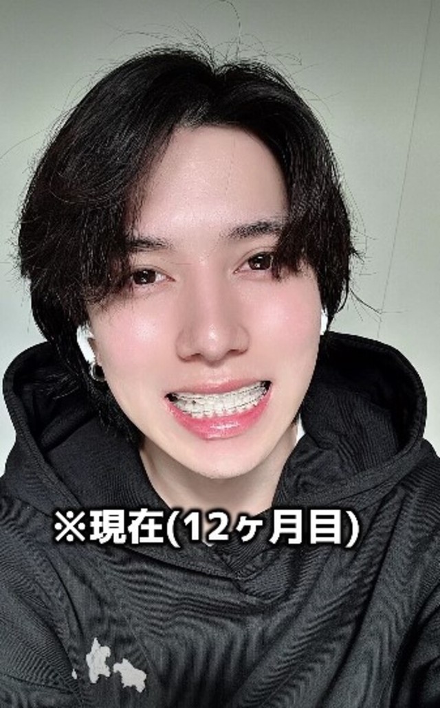 【After】現在（12カ月目）／歯並び地獄男さん（@akagankochan）提供