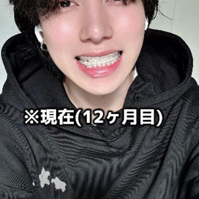 【After】現在（12カ月目）／歯並び地獄男さん（@akagankochan）提供