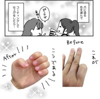 今まで悩んでいた深爪が…何ということでしょう！（みりこさん提供）