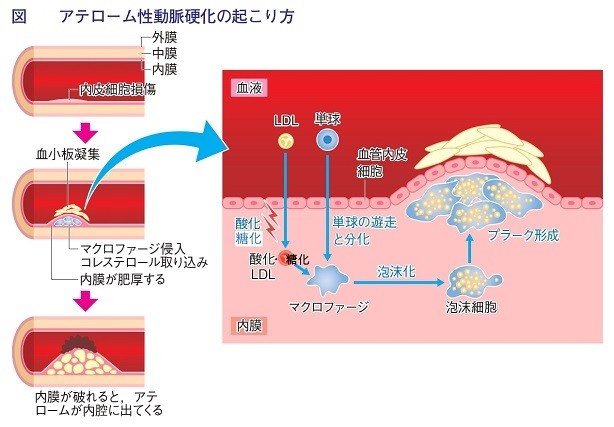 老化物質AGEとは? 過剰な糖化が原因 その仕組みとリスク