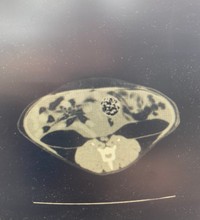 下側が背中、上がお腹側。丸い球体が腫瘍