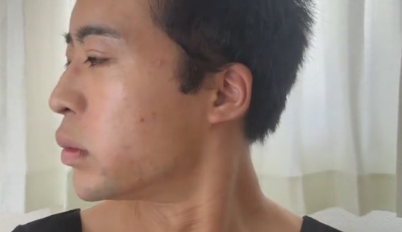 頬の脂肪を取り除く施術後／としきさん（@atarashiifuku）提供