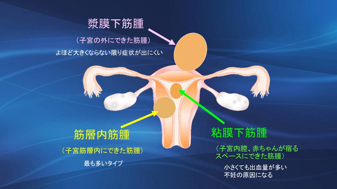 子宮筋腫の臨床 発育したり数が増えたりする子宮筋腫 今では、いろんな手術の選択が