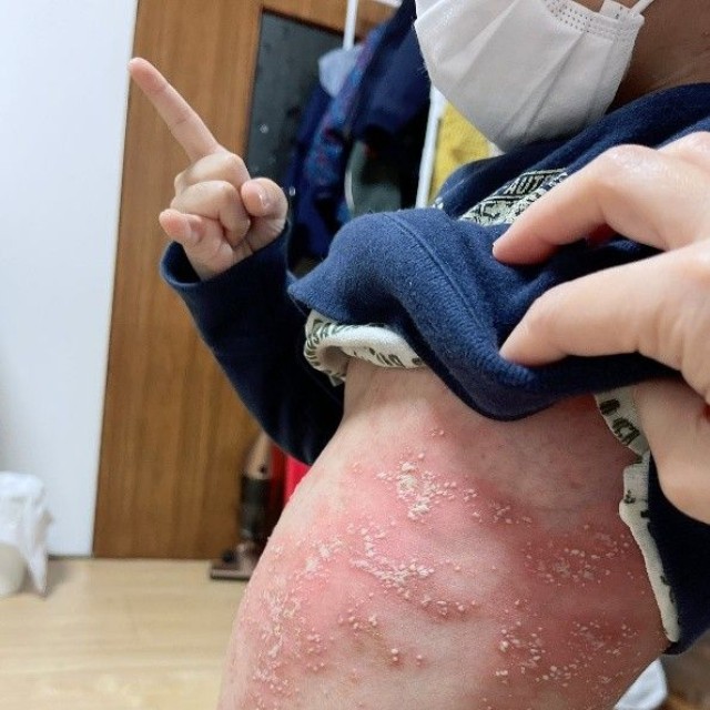 幼少期の息子さんの肌の状態