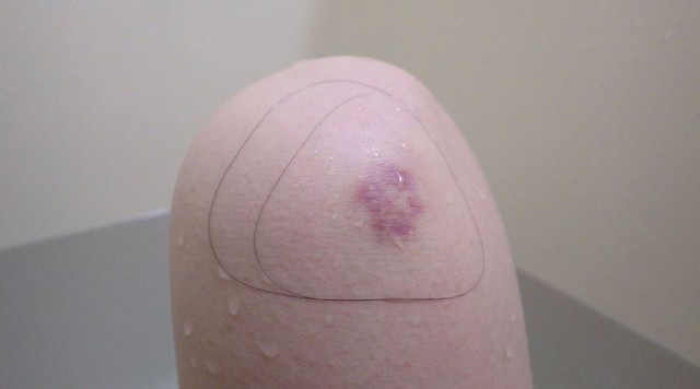 自身の身体のアザを梅干しに見立てた“おにぎり” ※杉浦由梨さん提供