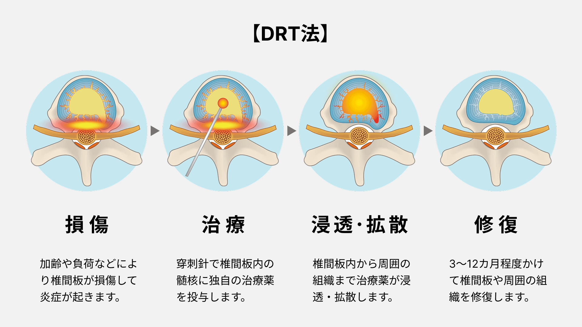 DRT法説明図