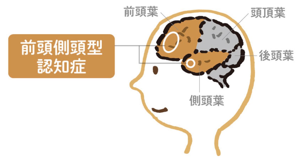 前頭側頭型認知症の3種類