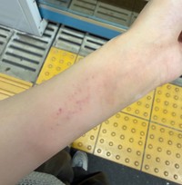 名誉の負傷…駅トイレでの救出エピソードが話題に（脱走したゴリラさん提供）