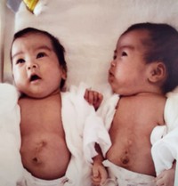 術後すぐの姉妹／長嶺姉妹さん（@sakahika）提供