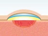 キズを覆い、湿ったまま体液をフル活用して治す「湿潤療法」のイメージ図
