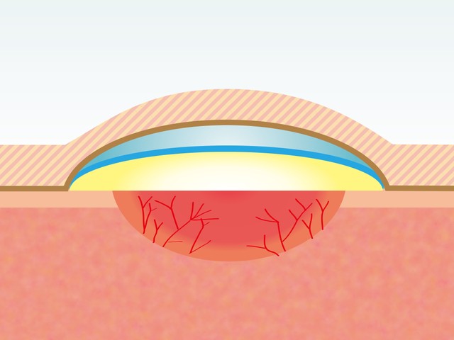 キズを覆い、湿ったまま体液をフル活用して治す「湿潤療法」のイメージ図