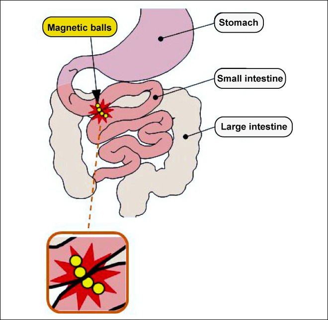 120 children needed treatment after accidentally swallowing magnetic balls:  consumer center - The Japan Times