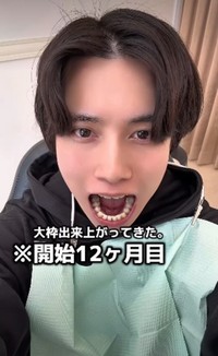 開始12カ月目「大枠出来上がってきた」／歯並び地獄男さん（@akagankochan）提供