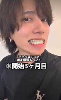 開始3カ月目「痛いけど頑張るんだ！」／歯並び地獄男さん（@akagankochan）提供