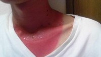 日焼け止めを首にだけ塗るの忘れてスイカのように真っ赤になってしまった肌の写真がTwitter上で話題に（ve®︎さん提供）
