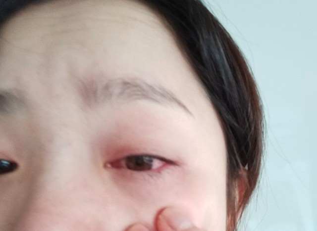 ドライアイの時には目が真っ赤に