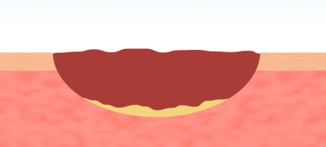 キズを乾燥させて治す場合のイメージ図。完治に時間がかかり、跡が残ることも多かった