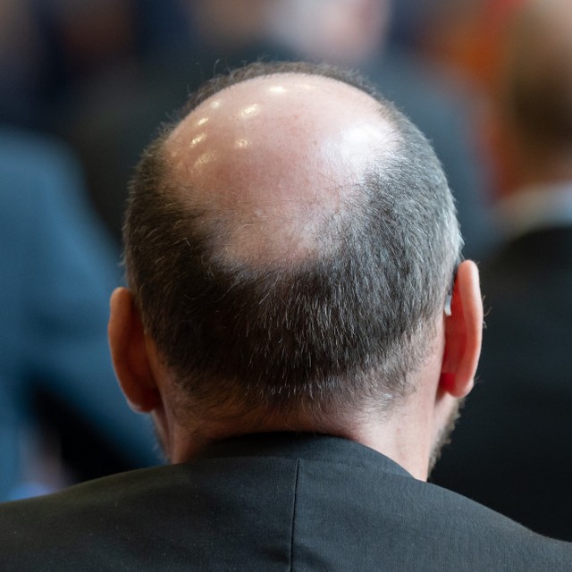 人間は薄毛に悩む必要がなくなるかもしれない　※写真はイメージです