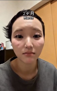 2カ月後（3月）のHANAさん。少しずつ伸び始めた頃／HANAさん（_hana8787_）提供