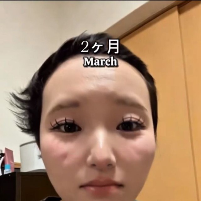 2カ月後（3月）のHANAさん。少しずつ伸び始めた頃／HANAさん（_hana8787_）提供