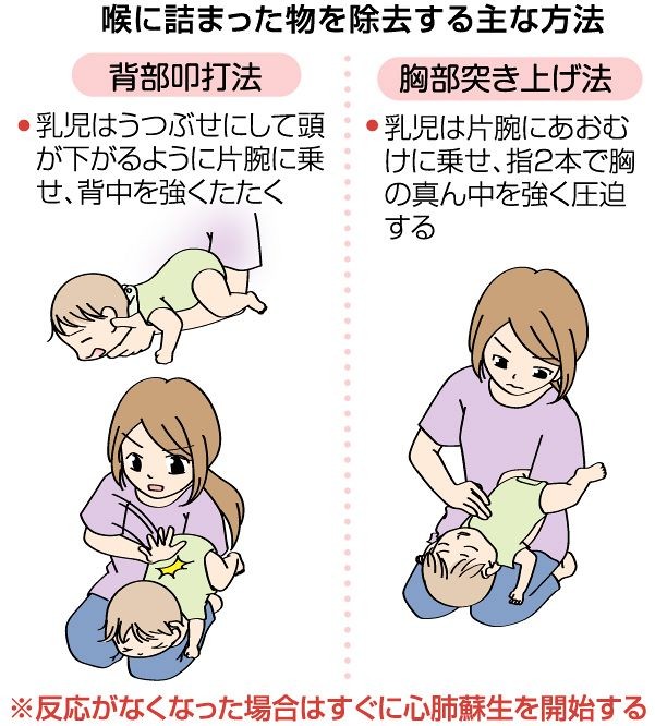 喉に詰まった物を除去する主な方法