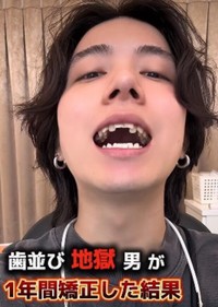 「歯並び地獄男が1年間矯正した結果」／歯並び地獄男さん（@akagankochan）提供＝画像をトリミングしています