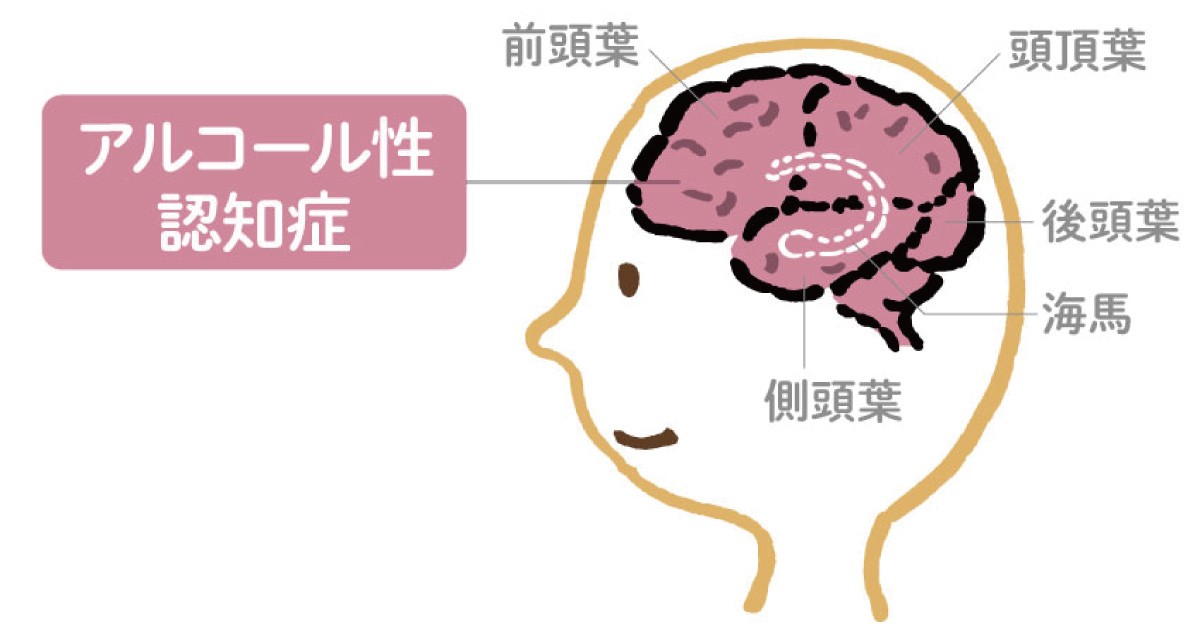 コルサコフ 症候群