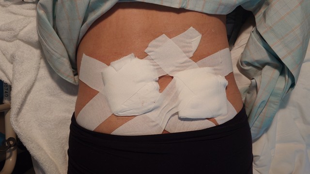 術後の腰部分は痛々しい…！