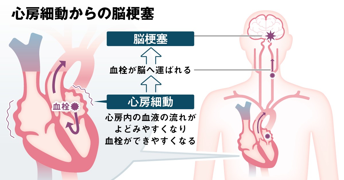 心房細動4