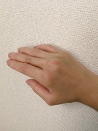 関節リウマチは、関節の腫れやこわばりといった症状が現れる