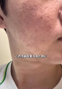 肌荒れに悩んでいたころ／れんさん（@zibunmigaki2024）提供