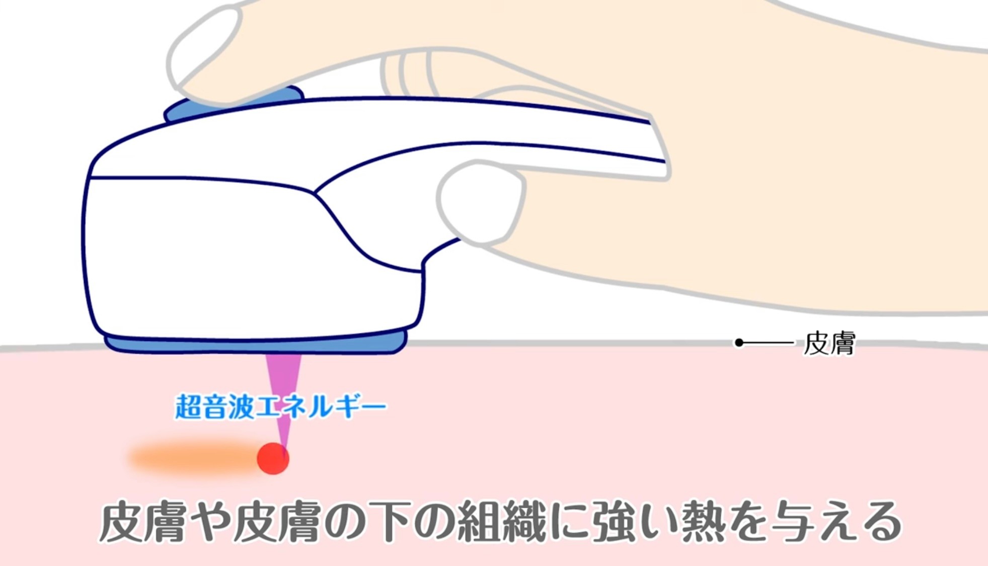 無意識によだれが…」美容ハイフによる顔面麻痺や視力障害相次ぐ、消費者庁が注意呼びかけ｜まいどなニュース