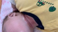 首回りの発疹