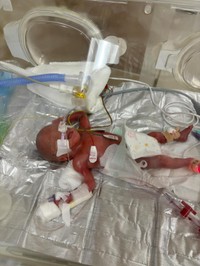 管に繋がれ、保育器の中で懸命に生きる次女の姿／sayakaさん（@syk.71）提供