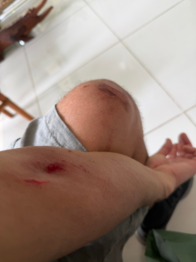 犯人を追いかけた末、路地裏で転倒し傷だらけに／石川貴也さん（@LWITBR1906）提供