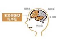 前頭側頭型認知症を専門医が徹底解説 家族へのアドバイスも