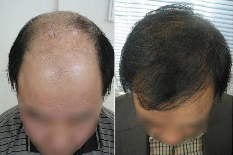 毛髪移植にはさまざまな種類がありますか?