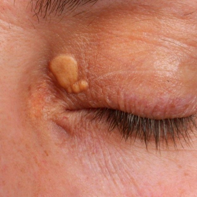 目元の黄色いできものができる眼瞼黄色腫※画像はイメージ