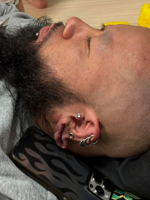 ピアスを外した状態(秋本みんみさん提供) 