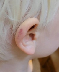 自分で日焼け止めの塗り直しができなかった頃には耳に火傷をしたことがあった